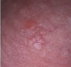 genital warts on penis head Daggett and ramsdell facial